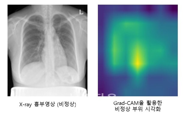 생성적 적대 신경망 합성 흉부 X-ray 영상