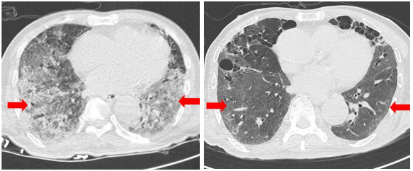 (▲ 줄기세포치료제 투여 전 흉부 CT(좌), 치료제 투여 106일 경과 후 흉부 CT(우)