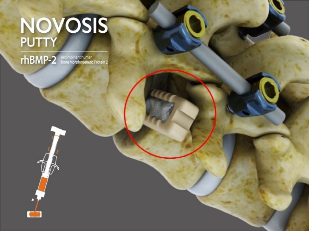 척추 유합술에 노보시스 퍼티(NOVOSIS PUTTY)를 적용한 모습