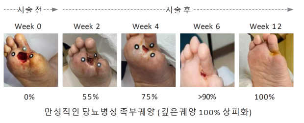 로킷헬스케어, 당뇨발 재생치료 혁신의료기술 국내 임상 허가 획득