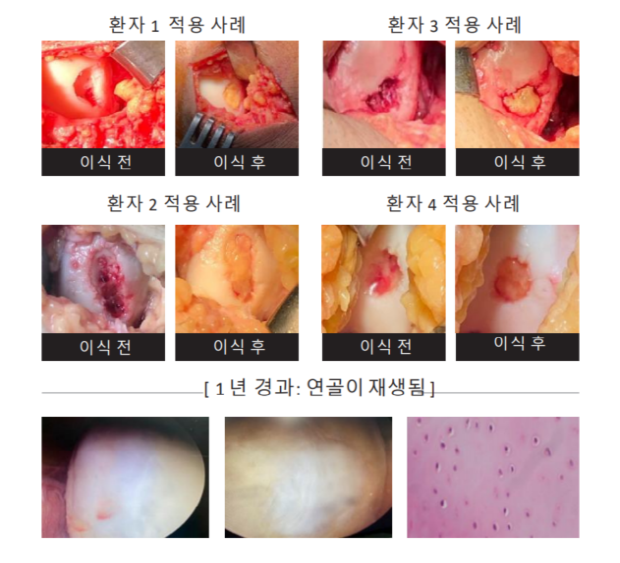 로킷헬스케어, 다국적 연골 임상 풀가동 '연골 재생 입증한다’