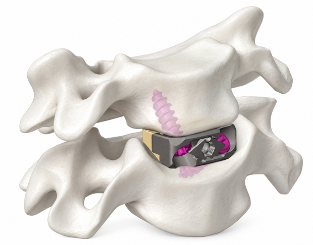 메디쎄이 사진자료 넥튠 SA 경추 케이지(NeckTune™ SA Cervical Cage)